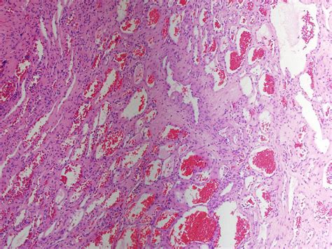 Capillary Hemangioma Lip Pathology Outlines