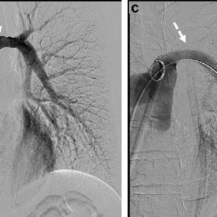 Embolization Of Pulmonary Artery With Onyx Ev3 Irvine California