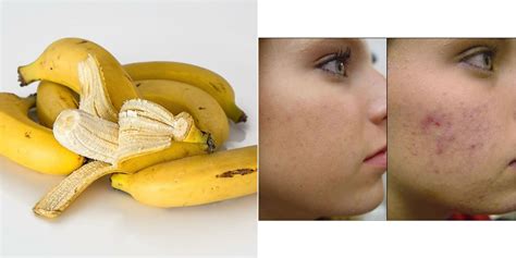 3 Mascarillas De Plátano Para Una Piel Más Joven Belleza