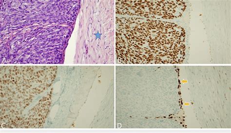 Histologic Evaluation And Staining Of Myoepithelial Carcinoma A