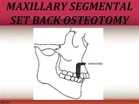 Treatment Of Class Ii Malocclusions Ppt