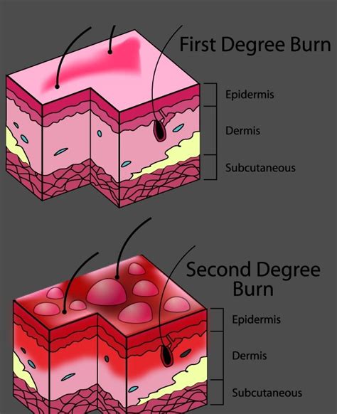 1st & 2nd Degree Burn | 2nd degree burns, Degree burns, Burn injury