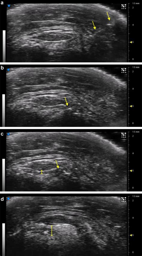 Accuracy Of Ultrasound Guided Versus Landmark Guided Intra Articular