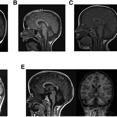 Mri Findings In Individuals With Mutation In Slc39a8 Mri Findings From