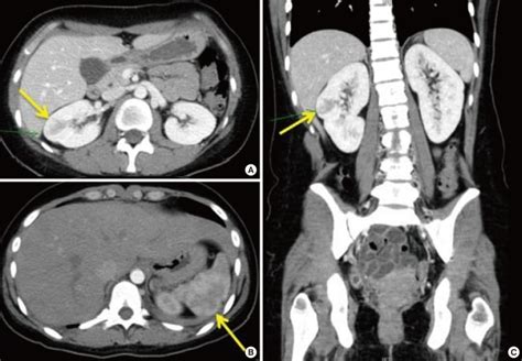 Abdominal Pelvic Ct Scan Showed Focal Wedge Shaped Low Density Lesion