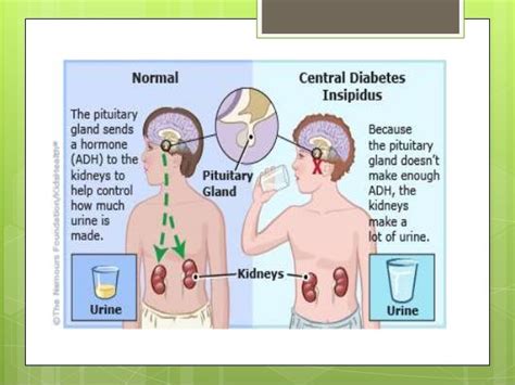 Diabetes Insipidus As Related To Diabetes Insipidus Nephrogenic Pictures