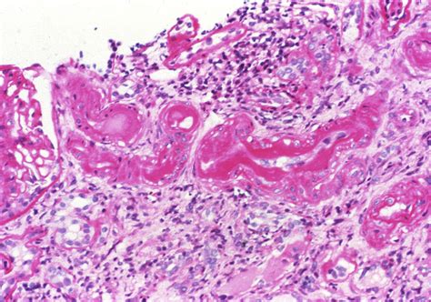 Ajkd Atlas Of Renal Pathology Arterionephrosclerosis American