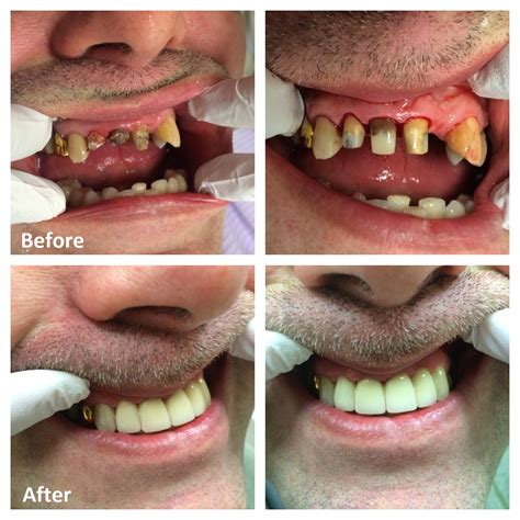 Dental Crowns 101 Types Of Dental Crowns And What The