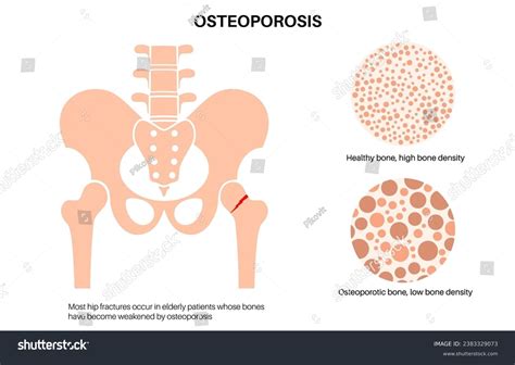 Hip Bone Fracture Photos and Images | Shutterstock