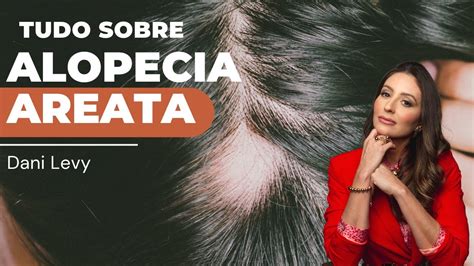 Alopecia Areata Os Melhores Tratamentos Youtube