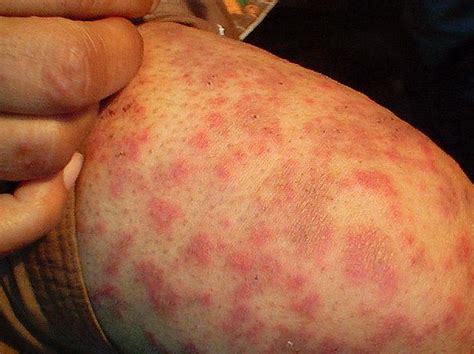 Dermatitis Herpetiformis Pictures Symptoms Causes Treatment