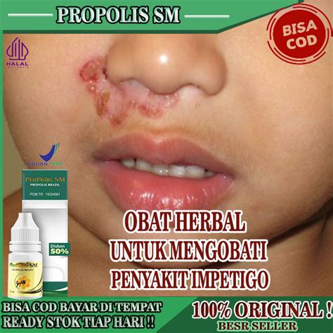 Jual Obat Penyakit Impetigo Obat Herbal Oles Impetigo Untuk Anak Dan