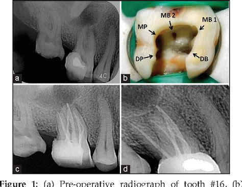 Cbct Diagnosis And Endodontic Management Of A Maxillary First Molar