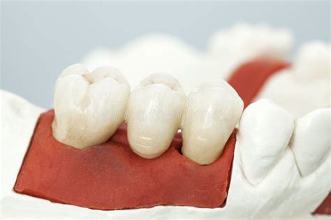 Metal Free Ceramic Dental Crowns Stock Image Image Of Dentist Clinic