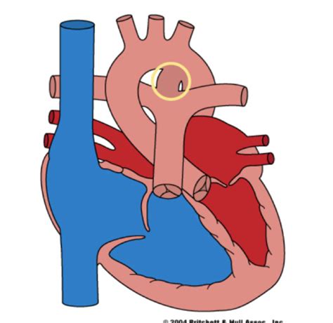 Congenital Heart Defects Flashcards Quizlet