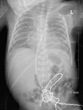 Malpositioned Umbilical Catheters Radiology Case Radiopaedia Org