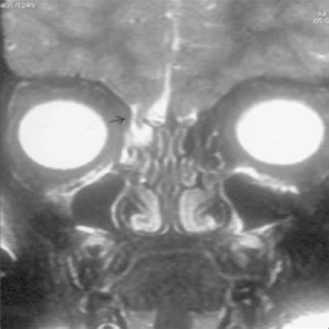 Herniation Of Fovea Ethmoidallis Through Right Cribriform Plate With