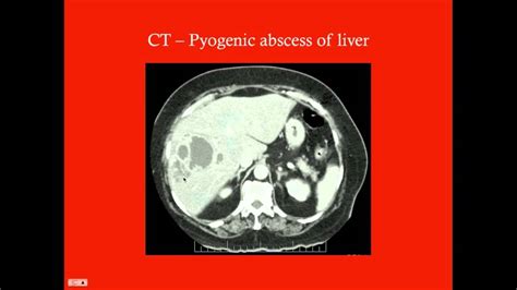 Pilonidal Cyst Vs Abscess