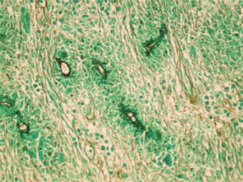 Grocottgomori Methenamine Silver Staining Showing Fungi With Positive Download Scientific