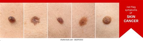 Skin Moles Types