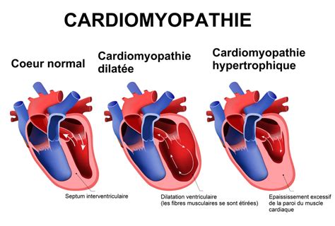 Cardiomyopathie Sympt Mes Cause De Quoi