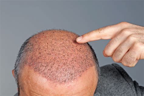 How Effective Hair Transplant Is Its Types Health Eveready