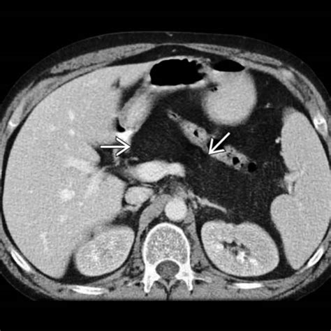 Cystic Fibrosis Radiology Key