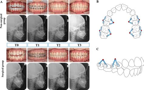 A Serial Intraoral Photographs And Lateral Cephalometric Radiographs