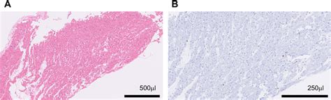 Histopathological Findings Of Myocardial Biopsy With Hematoxylin Eosin