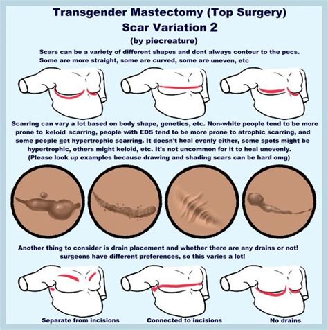 Instructions For How To Get Rid From Breast Surgery