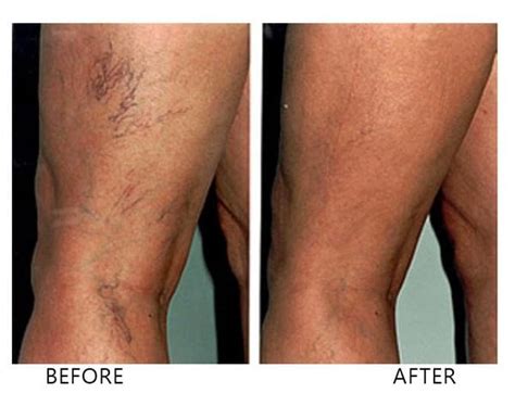 Laser Vein Treatment Mississauga Skincare Laser Centre