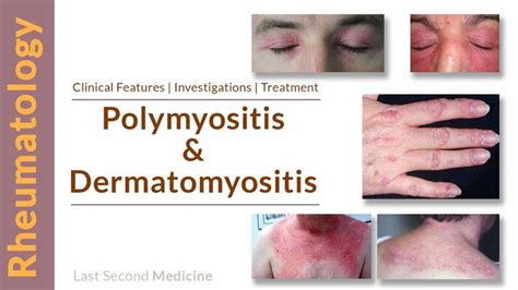 A Simplified Overview Of Polymyositis And Dermatomyositis Clinical