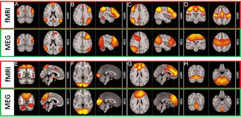 Magnetoencefalograf A Una Ventana Al Interior Del Cerebro Mediante Sus