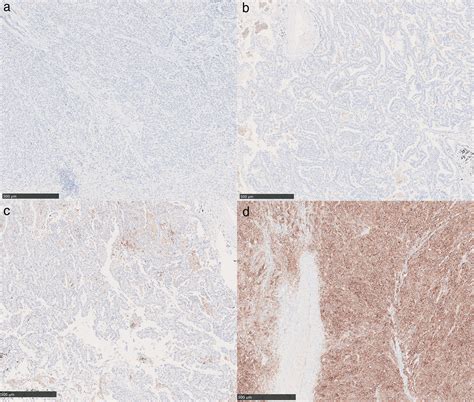 Clinical Significance Of ≥ 50 Pd‐l1 Expression With The Sp263