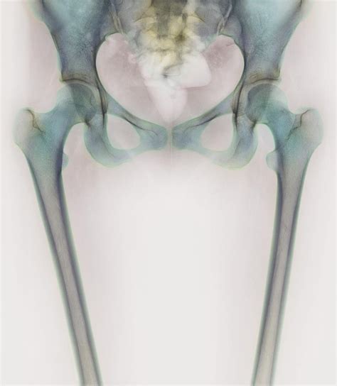 Hip Bones, X-ray Photograph by | Pixels