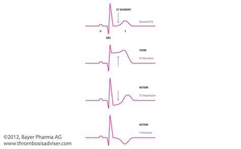 Understanding differences between stemi and nstemi - Nursing Student Assistance