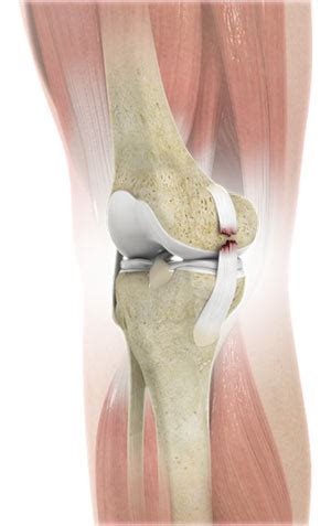 Medial Collateral Ligament MCL Injury Sydney, NSW | MCL Tear Randwick