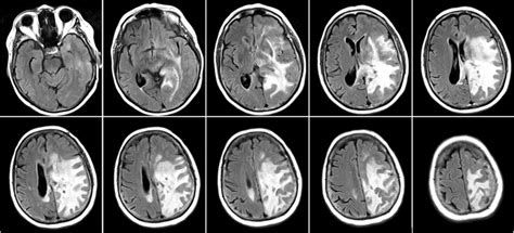 Fluid Attenuated Inversion Recovery Flair Sequence Of The Initial Mri Download Scientific