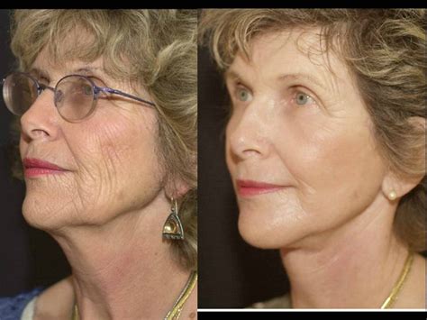 Laser Skin Resurfacing Sadove Cosmetic Surgery