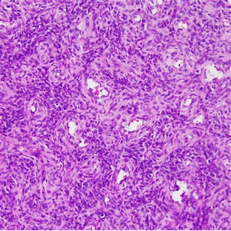 Calcifying Aponeurotic Fibroma A Showing Foci Of Calcification And