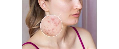 Tak Perlu Beli Acne Patch Ini Trik Redam Munculnya Jerawat Agar Tak