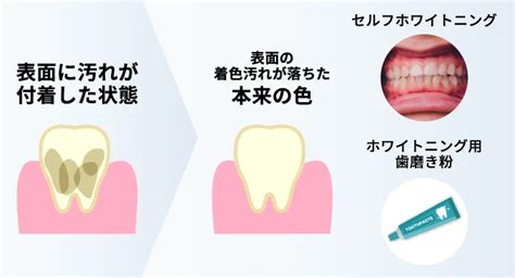 セルフホワイトニングでは白くならない効果が実感できるホワイトニングを解説ホワイトエッセンス