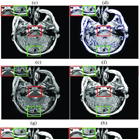 Pdf Multi Modal Medical Image Fusion With Adaptive Weighted