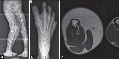 Macrodystrophia Lipomatosa A Single Large Radiological Study Of A Rare