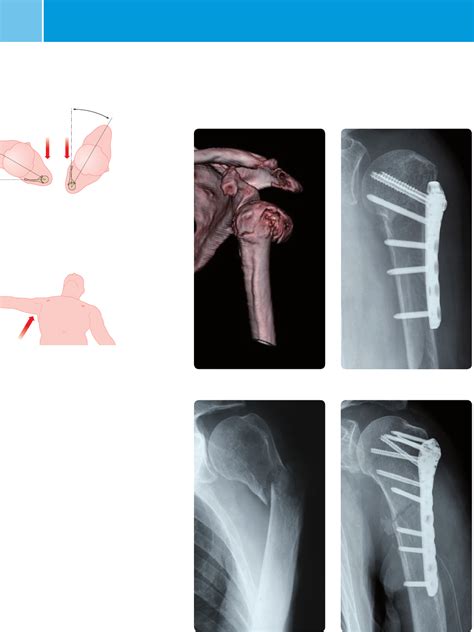 Ncb Proximal Humerus Surgical Technique System