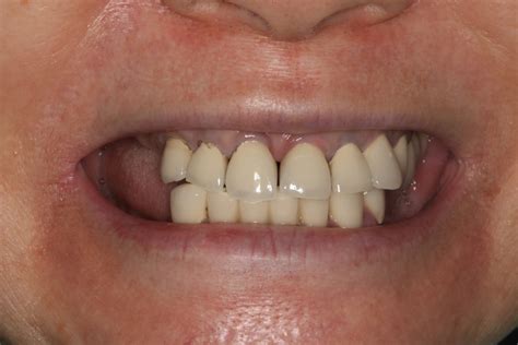 All On Gallery Pacific Smiles Dental Implant Center