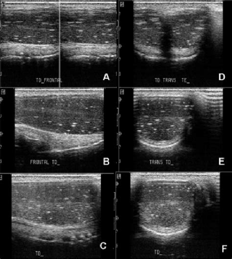 Imagem Ultrassonogr Fica Em Plano Frontal A B C Demonstrando O