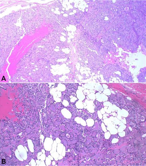 Photomicrograph Of The Surgical Specimen Showing The Follicular