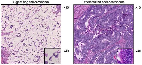 The Representative Microscopic View Of Signet Ring Cell Carcinoma In Download Scientific