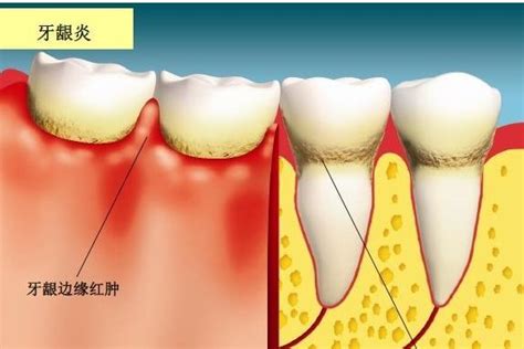 牙龈炎、牙周炎、牙髓炎，傻傻分不清？ 知乎